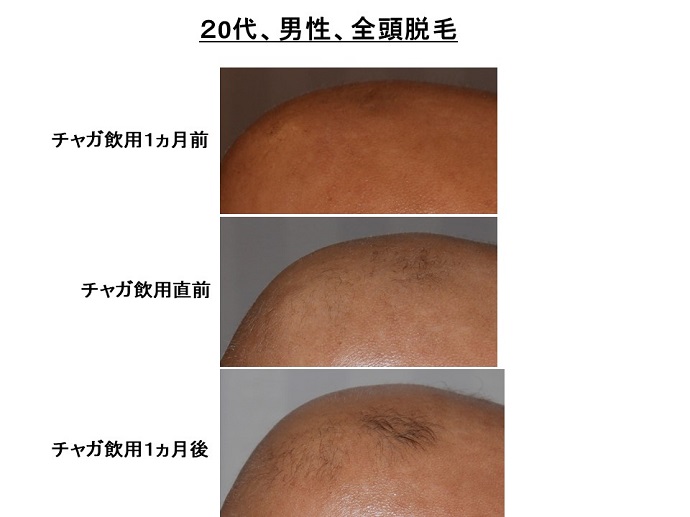 円形脱毛症　病院